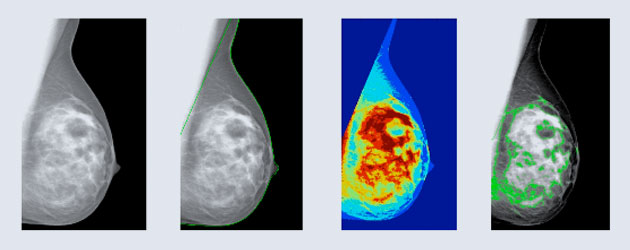 Breast density estimation from digital mammography
